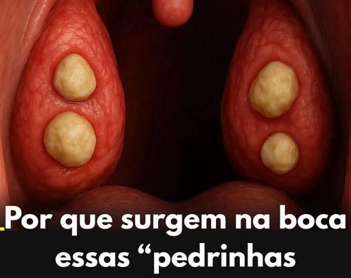 O que são essas ‘pedras brancas’ que aparecem na boca que causam mau hálito?
